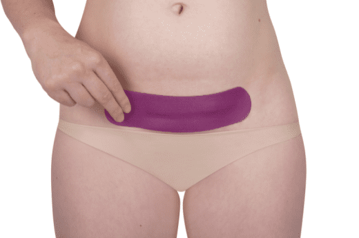 Scarban C-Section