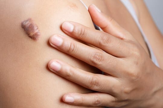 Wat Is Een Keloid Litteken En Hoe Behandel Je Ze? - Scarban