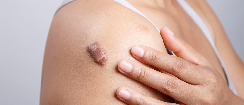 Scar,On,Human,Skin,,Keloid,On,Shoulder
