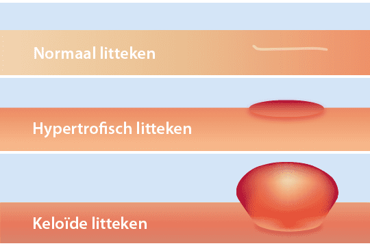 verschillende soorten littekens