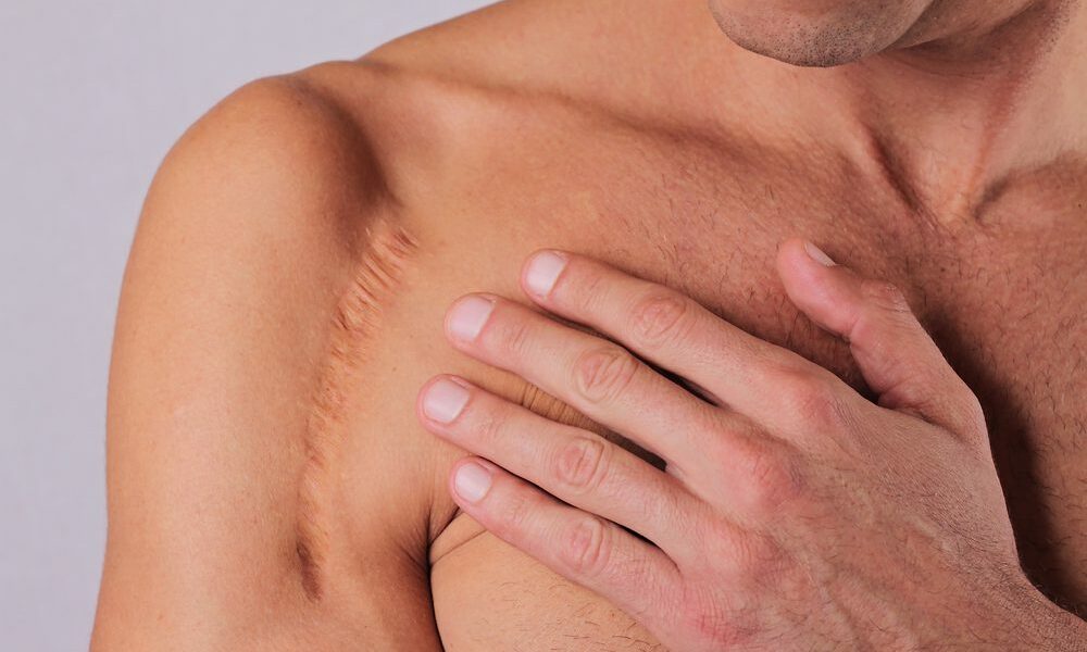 Man,Man,With,Scar,On,His,Hand,Shoulder.,Laser,Scar