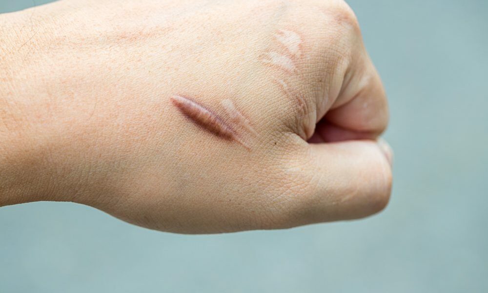 Keloid,Scar,(hypertrophic,Scar),On,Man,Hand,Skin,After,Accident.