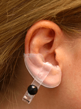 Oorclip keloïd oor