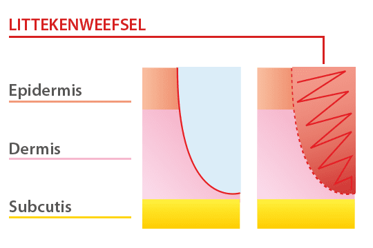 SB.Doorsnede.huid.littekenweefsel.NL